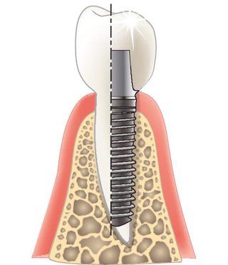 Implantat _ idel.org für Drs. Kleier&Schlieper _
 AI